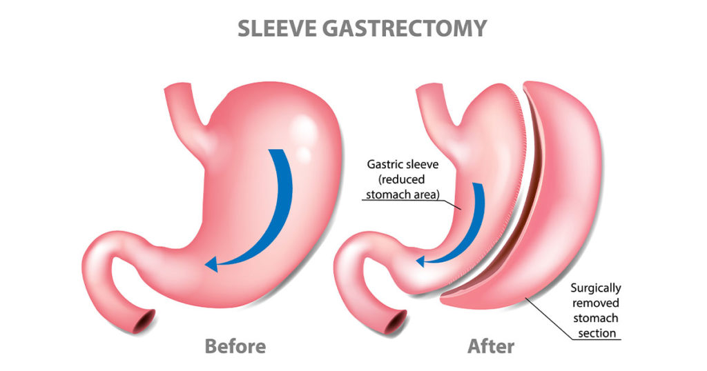 HighQuality Best Laparoscopic Sleeve Gastrectomy In India