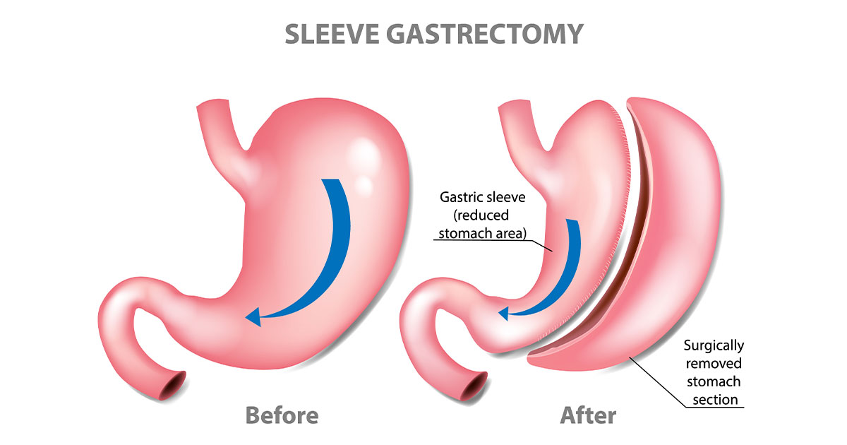 HighQuality Best Laparoscopic Sleeve Gastrectomy In India