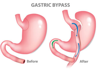 High-Quality Best Gastric Bypass Surgery Cost in India