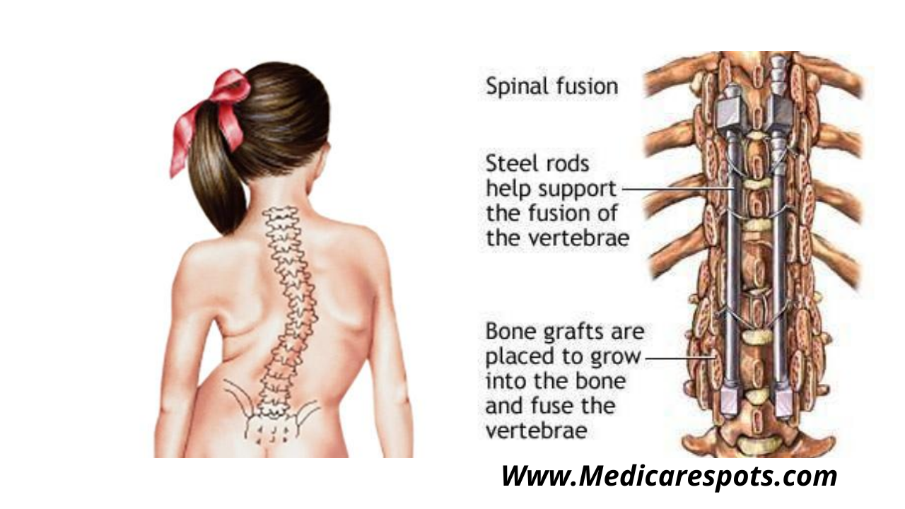 Best Scoliosis Surgery Cost In India 2023 Medicare Spots