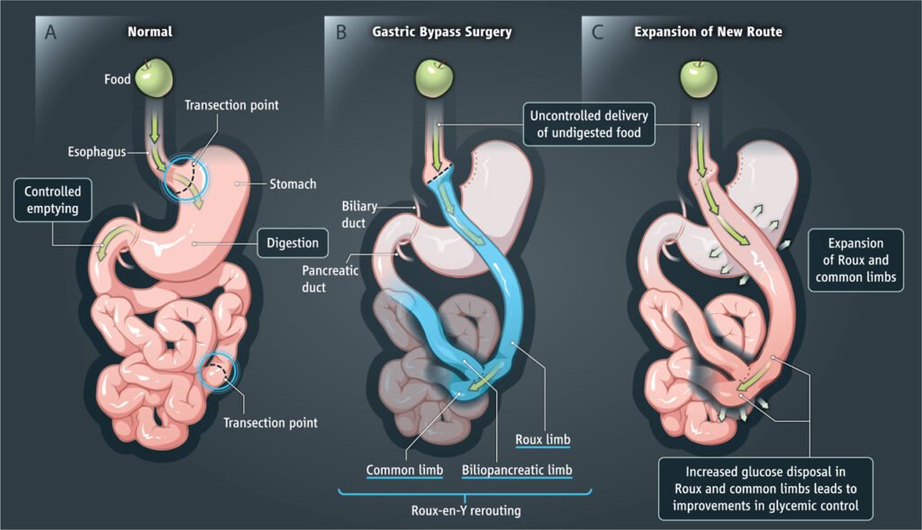 HighQuality Best Gastric Bypass Surgery Cost In India 2020