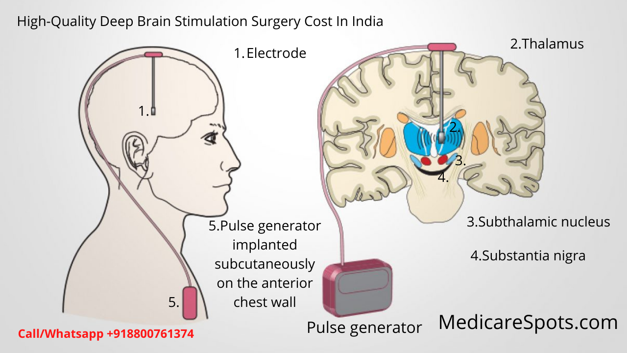 Deep Brain Stimulation (DBS) Cost Surgery In India 50 Discount