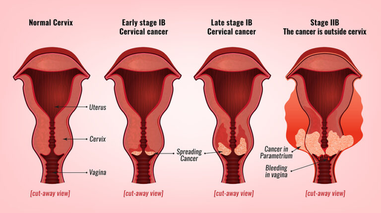 Cervical Cancer Treatment Cost in India