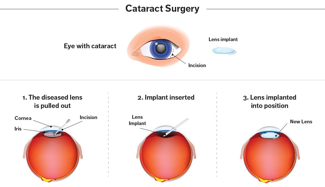 Best Cataract Surgery Cost In India Medicare Spots