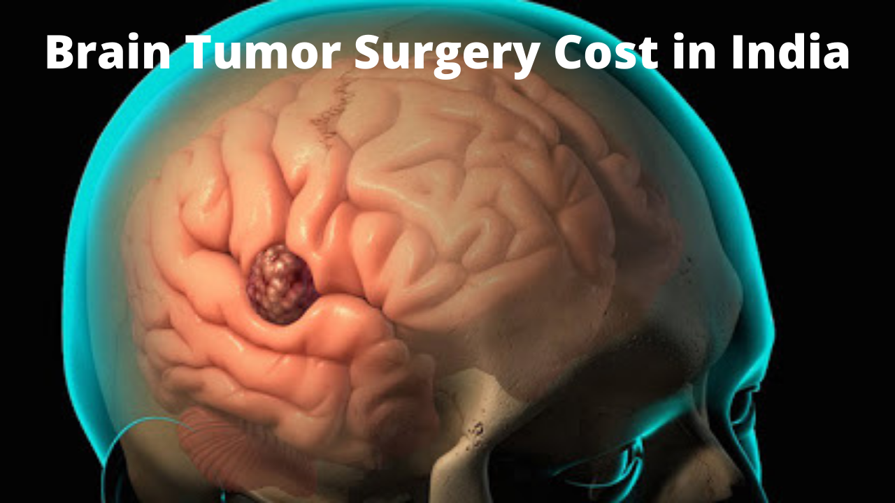Best Brain Tumor Surgery Cost In India | Brain Tumor Treatment In India
