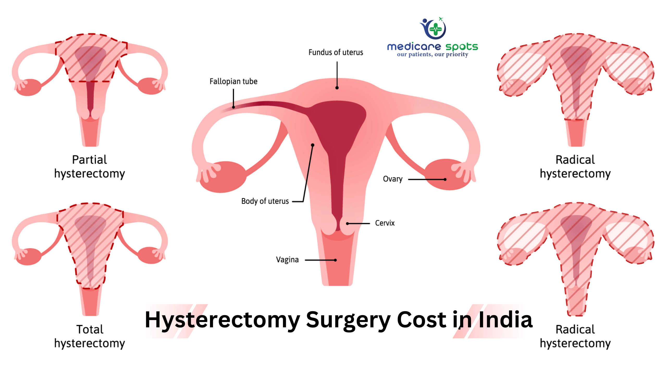 Best Hysterectomy Surgery Cost In India 2023 | Medicare Spots